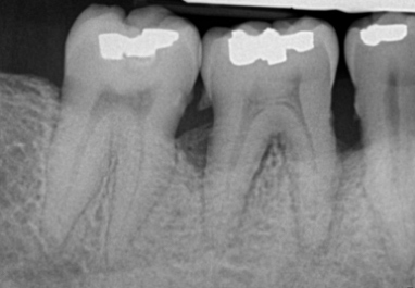 x-ray of teeth before implants