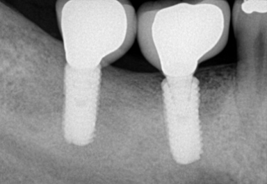 x-ray after implant
