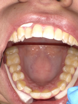 teeth before orthodontics