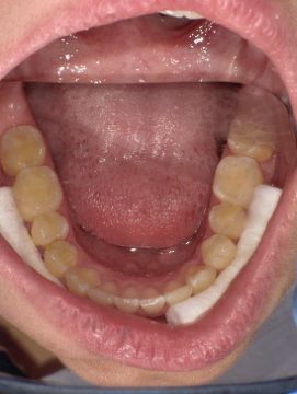 teeth after orthodontics