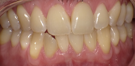 teeth after orthodontics