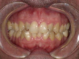 teeth before orthodontics